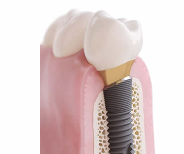 Choosing a Professional for Your Dental Implants in Haymarket